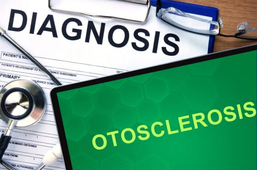 otosclerosis audiopacks otosclerosi