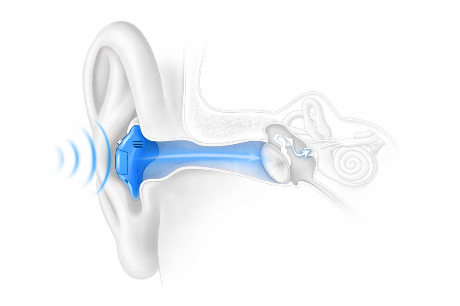 audifono funcionamiento