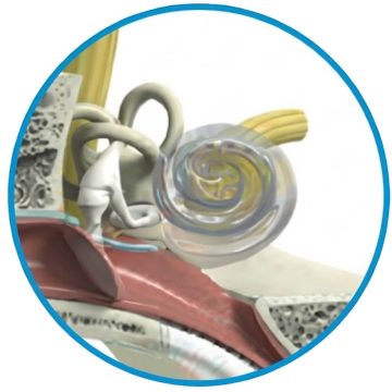 implant coclear funcionamiento coclea
