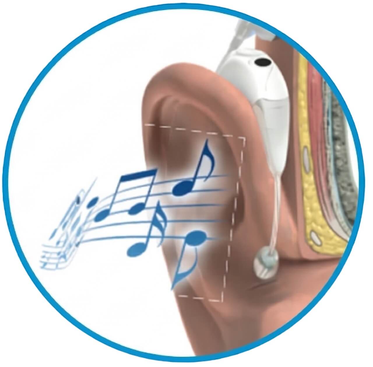 implant coclear funcionamiento microfono