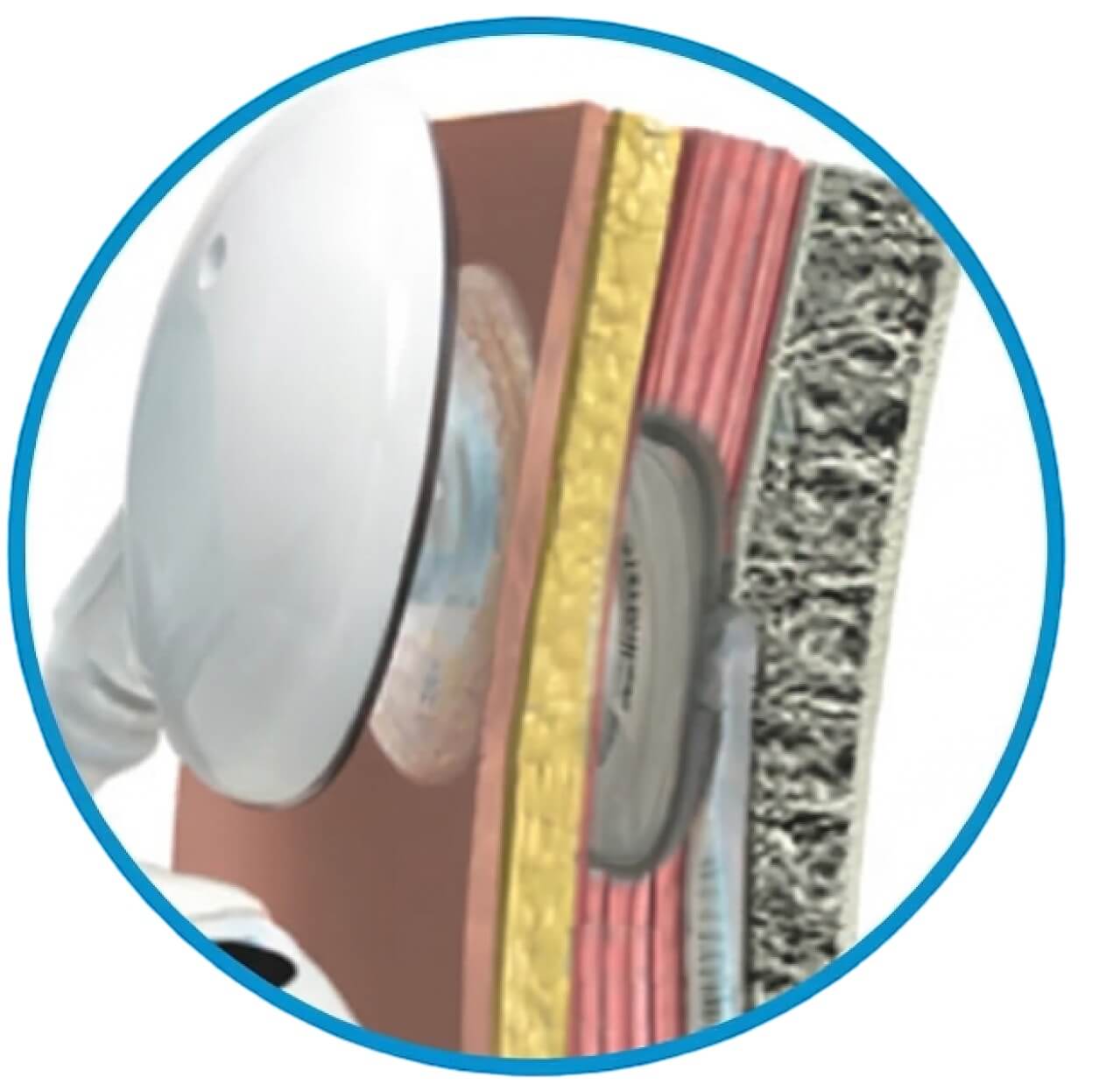 implant coclear funcionamiento receptor