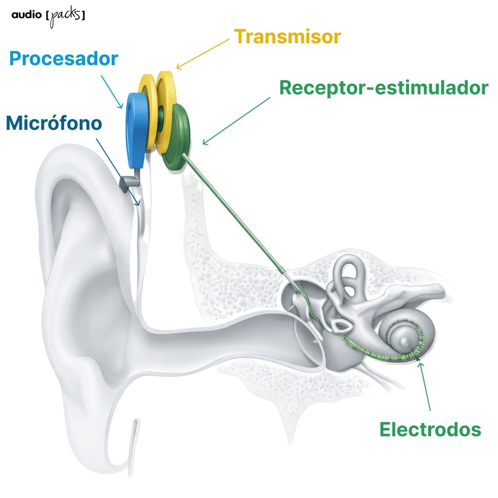 implante coclear partes